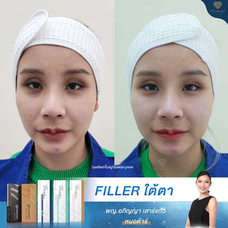 Teen 6 Under Eye Filler Before After