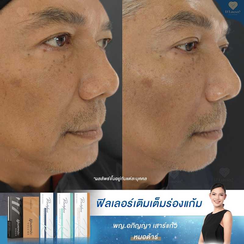 Under Eye Filler Before After Male 26