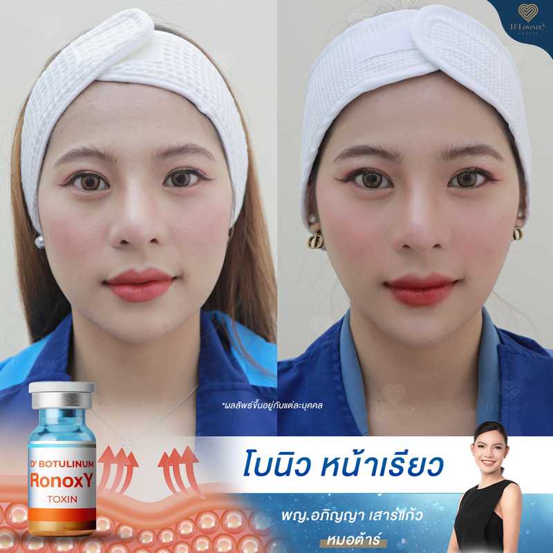 V Shape Botox Jaw Slim Before After Clinic