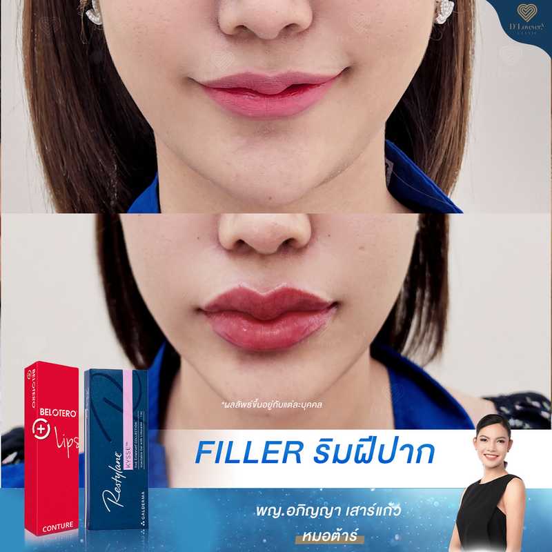 Volume Lip Filler Before After