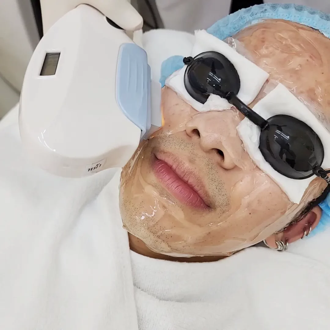 Laser acne scar treatment: patient with gel-covered face, protective goggles, handheld device.