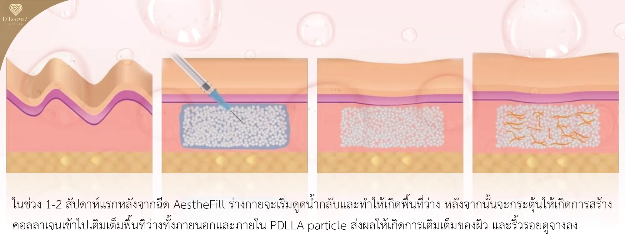 AestheFill ช่วยเรื่องอะไรบ้าง