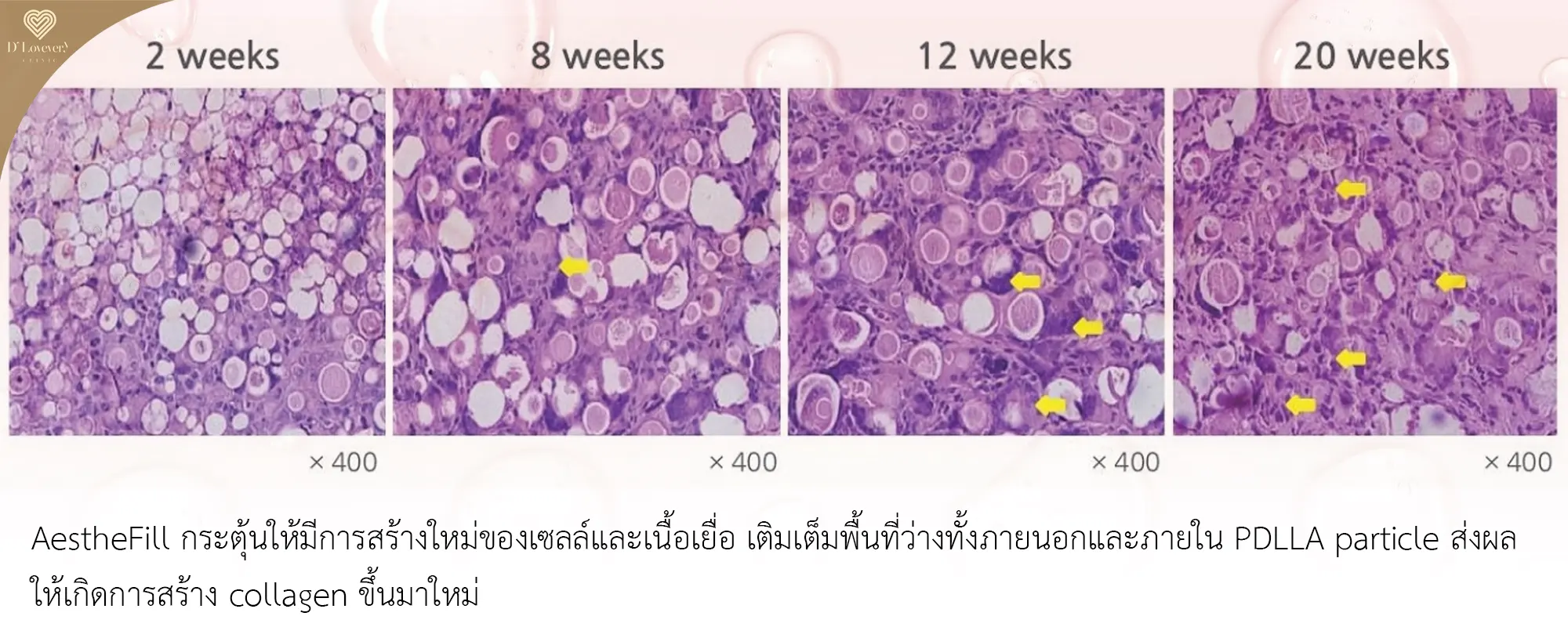 AestheFill ดีไหม ดีเลิฟเวอรี่คลินิก
