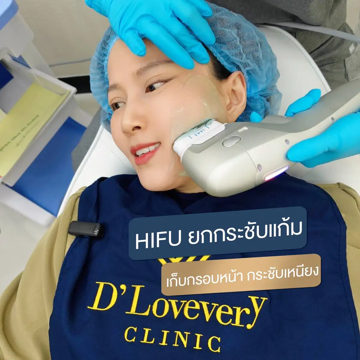 HIFU cheek lift treatment on 40s patient at DLovevery Clinic