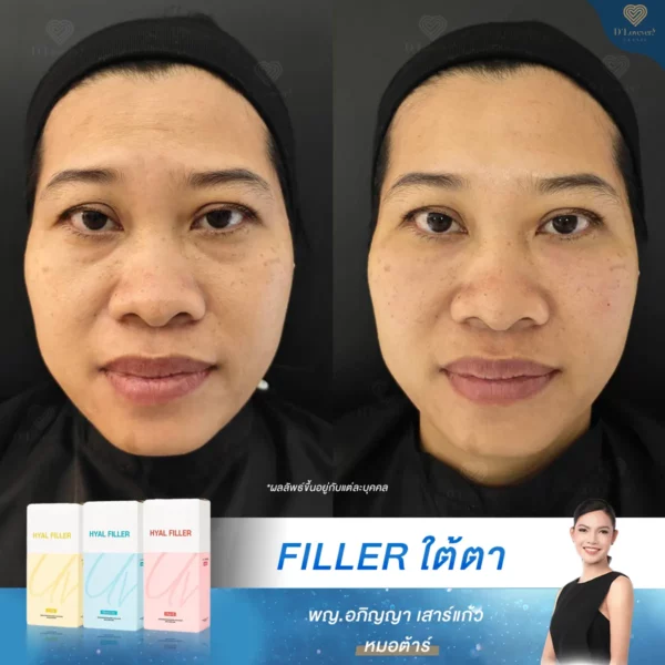 รีวิวฟิลเลอร์ใต้ตา ultra v hyal filler
