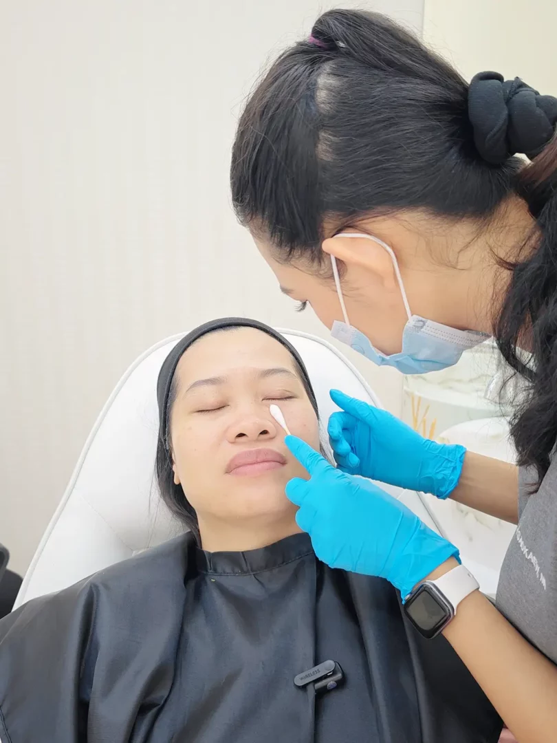 รีวิวฉีดฟิลเลอร์ใต้ตา ultra v hyal filler ดีเลิฟเวอรี่คลินิก