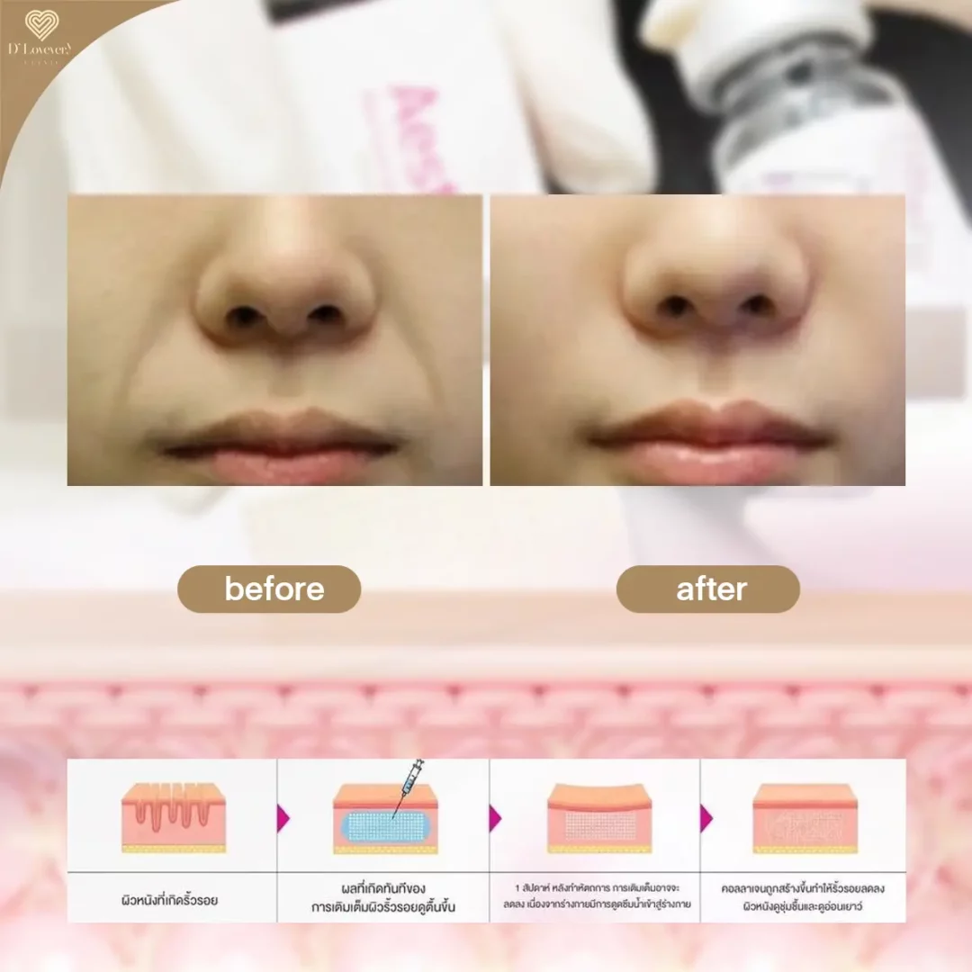 aesthefill รีวิว