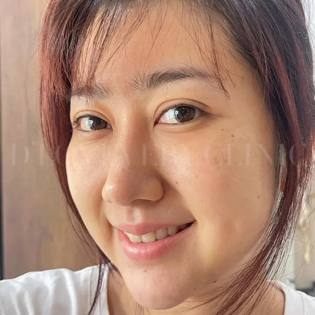 Rejuran one-week results: close-up of smiling womans natural skin glow