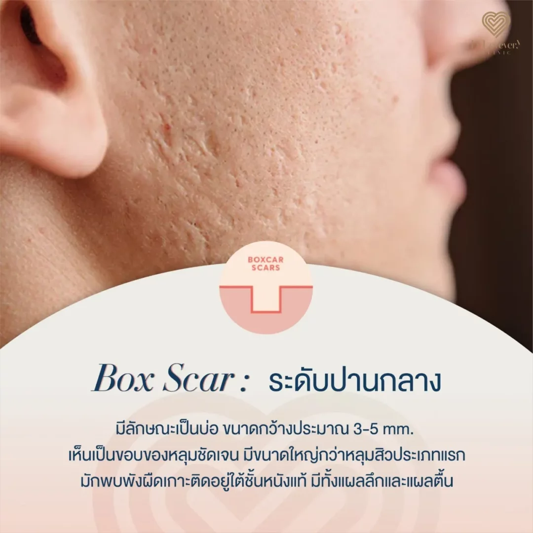 Close-up cheek with boxcar acne scars (3–5 mm) — clinical photo
