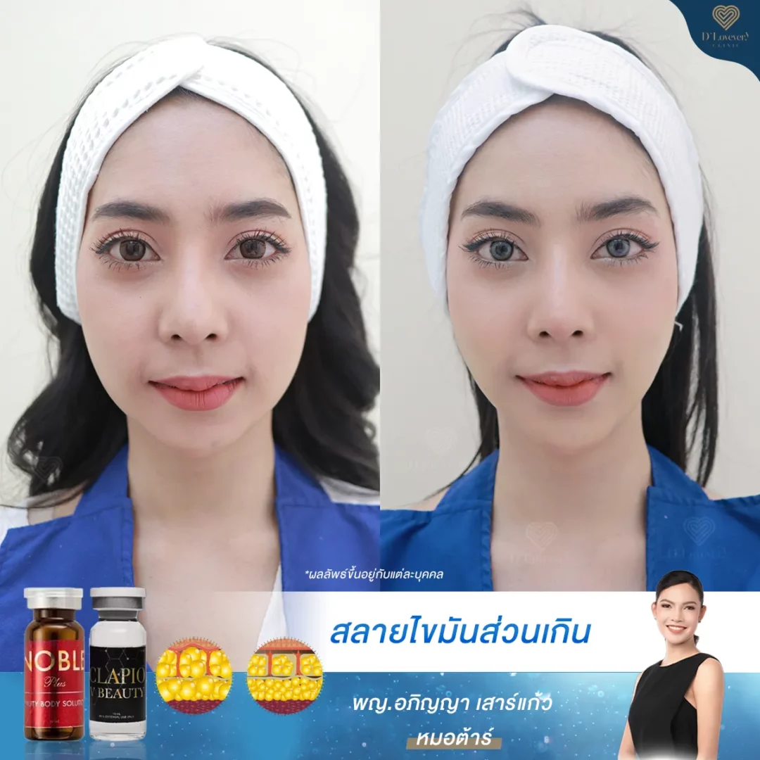 Cheek fat injection before and after results — slimmer jawline, smoother skin