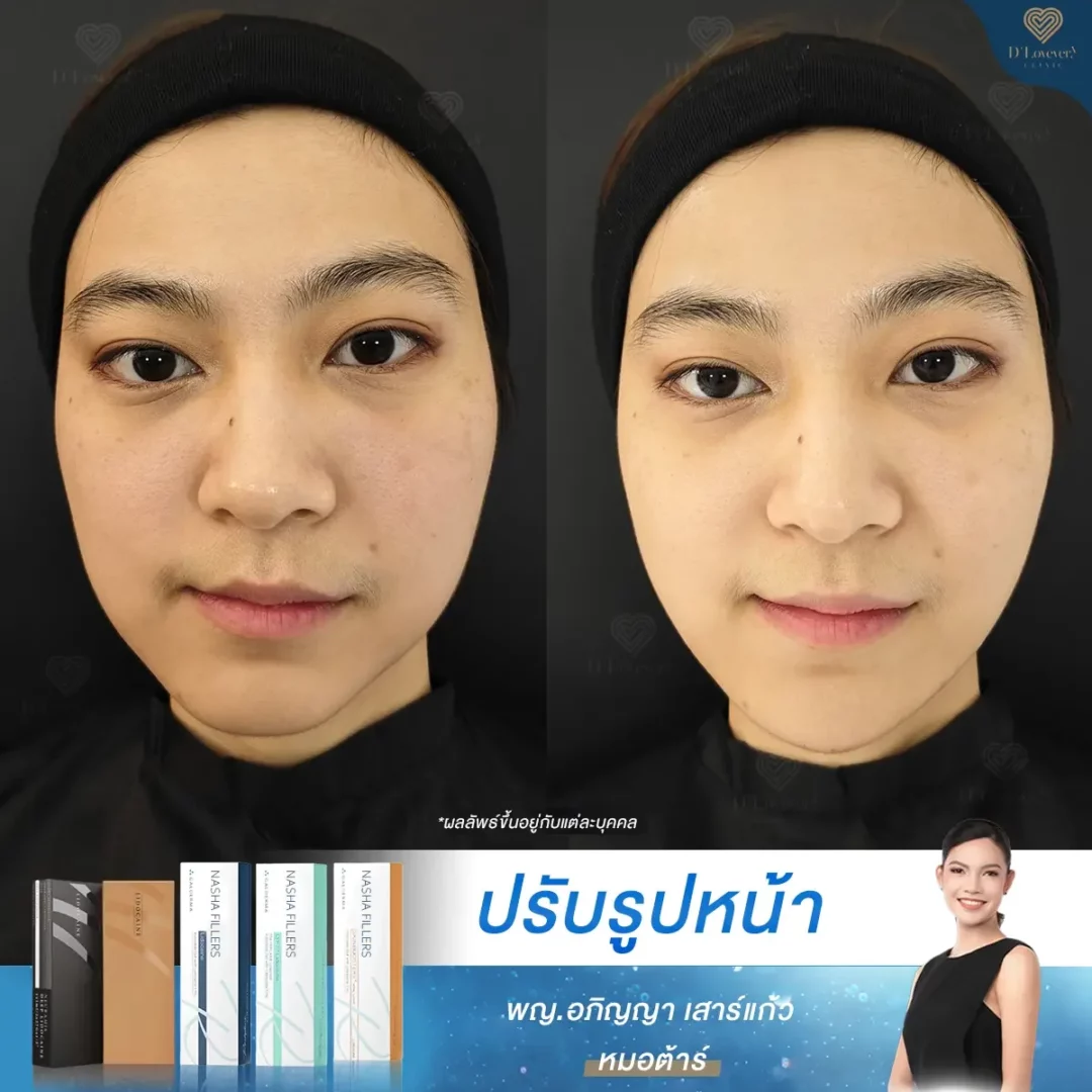 หน้าไม่เท่ากัน ฉีดอะไรดี ฟิลเลอร์คือคำตอบ