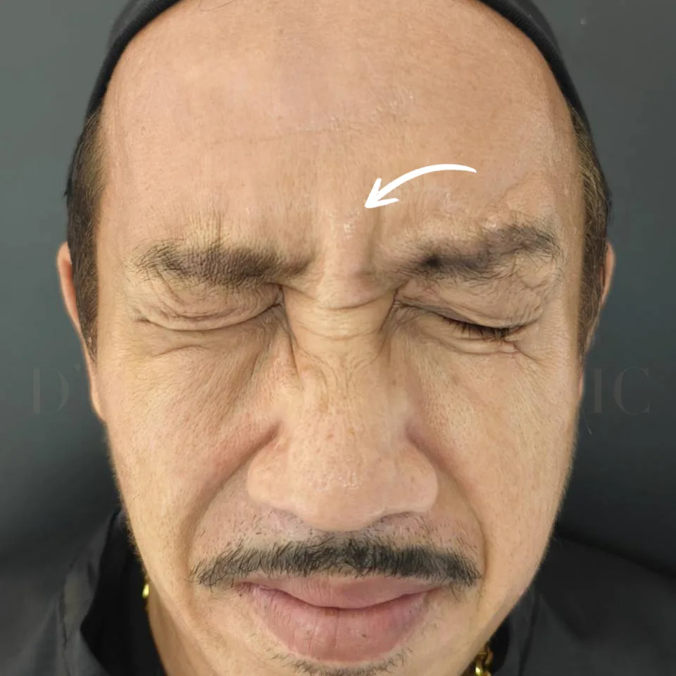 Close-up of man squinting showing glabellar lines and forehead for Botox treatment.