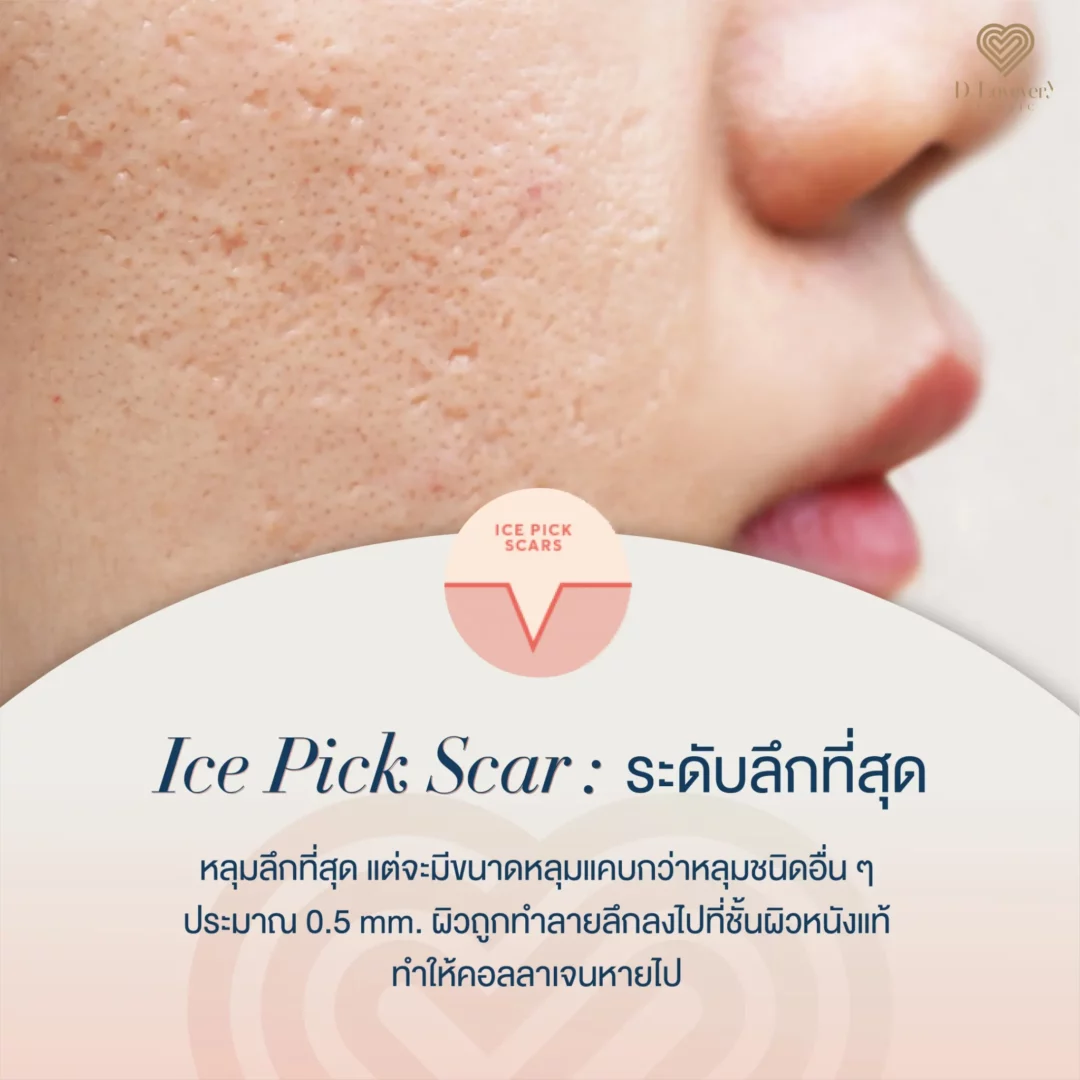 Close-up cheek showing deep ice pick acne scars and textured pores