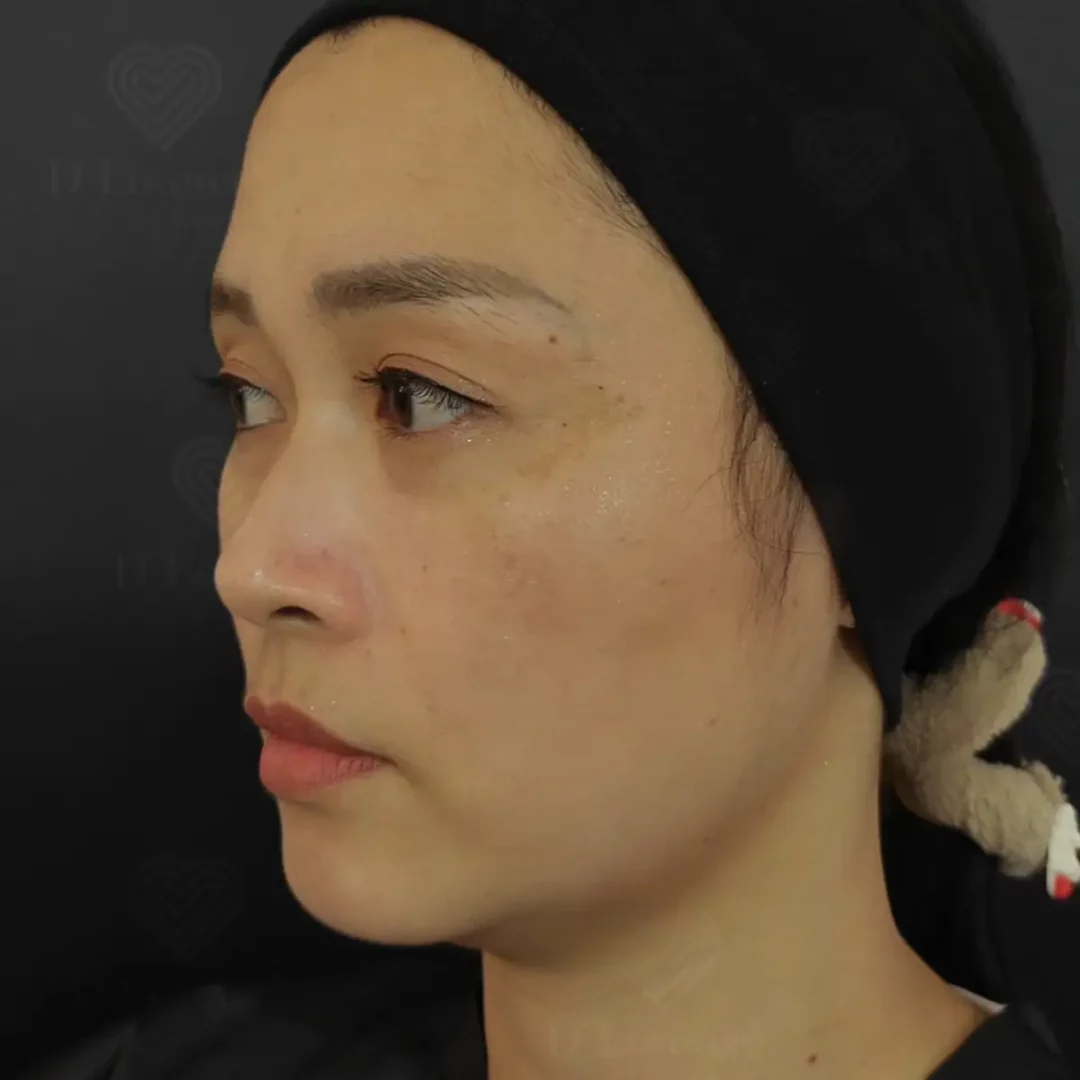 علاج النمش والكلف على عظام الخدين: مراجعات.