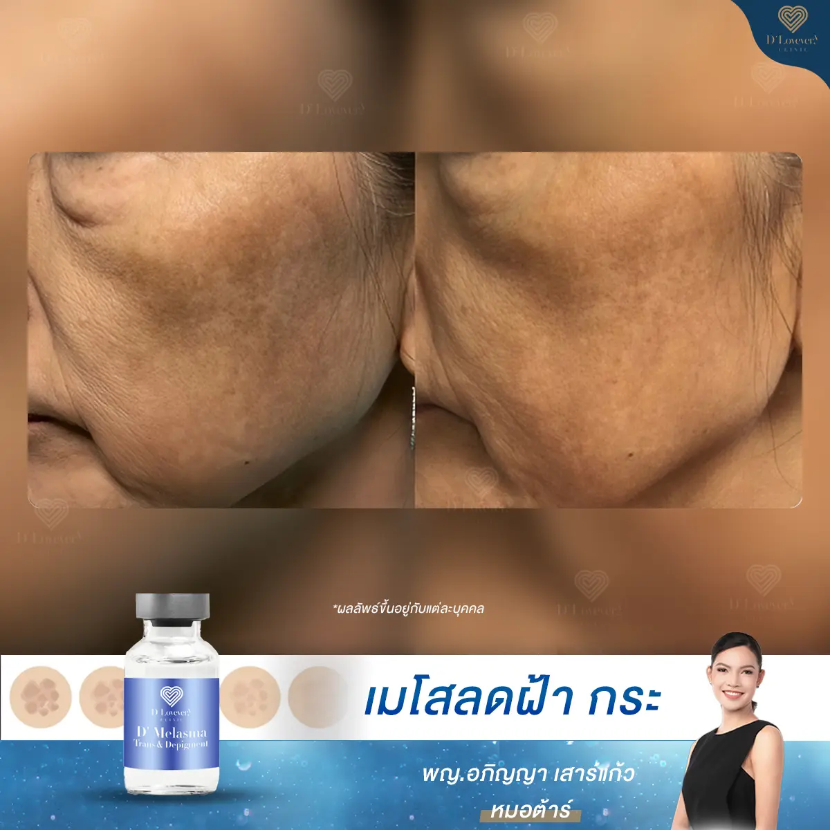Melasma before and after natural treatment for uneven pigmentation and age spots