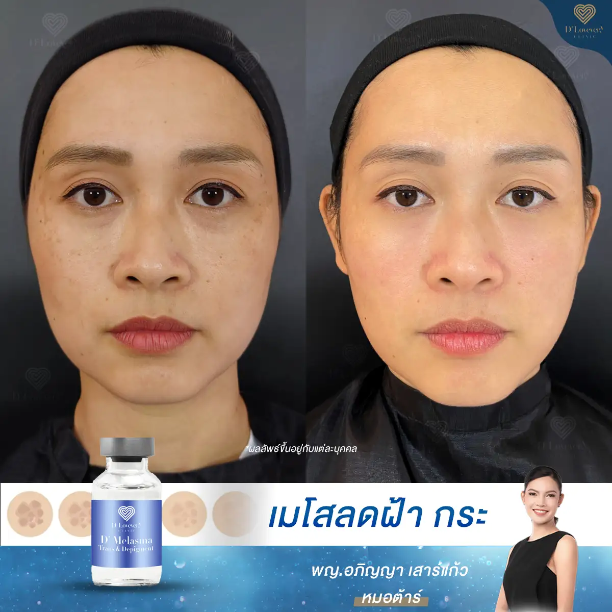 مراجعة الحقن المستخدمة للحد من الكلف. D' Lovevery Clinic