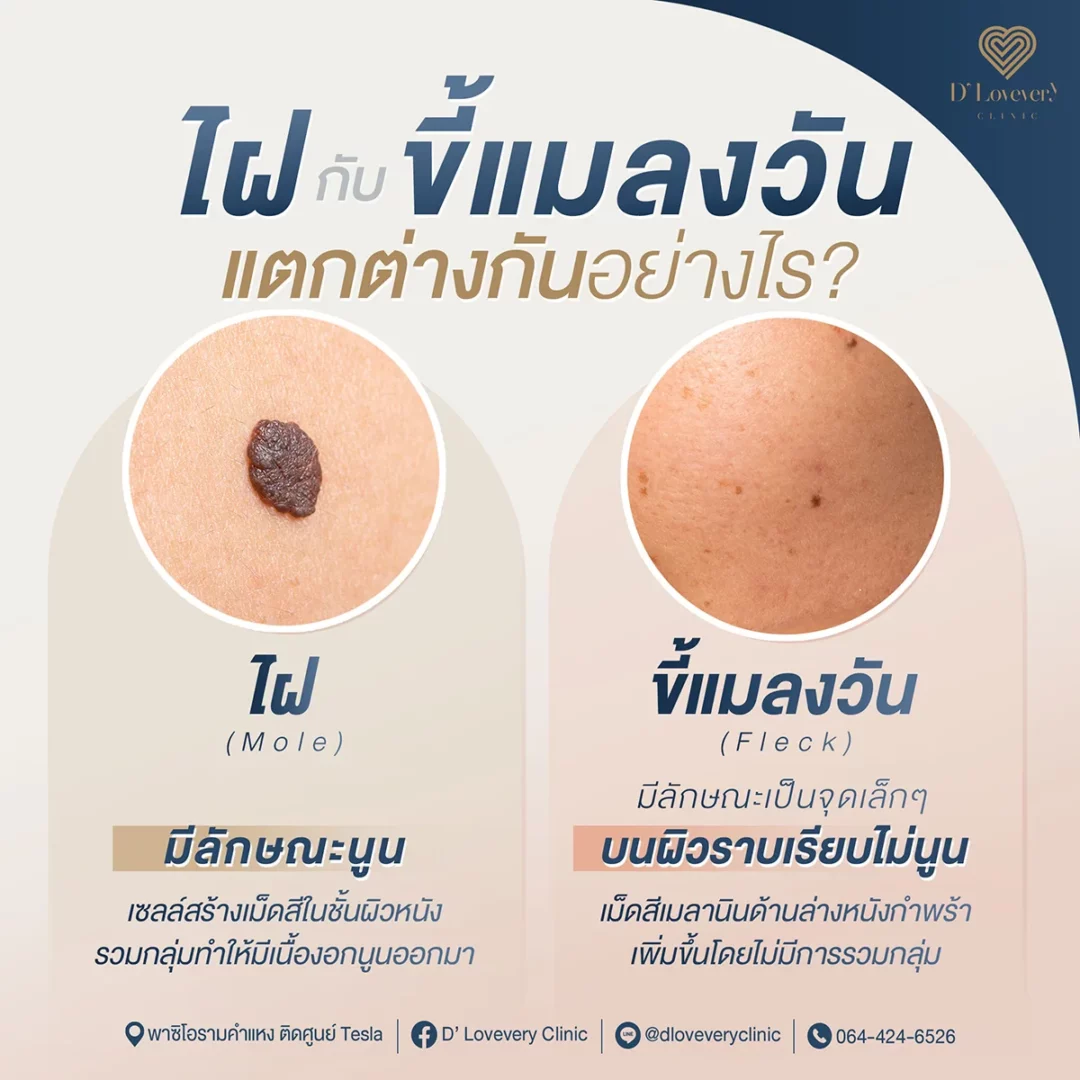 Mole vs Freckle: raised dark mole and flat light freckle comparison