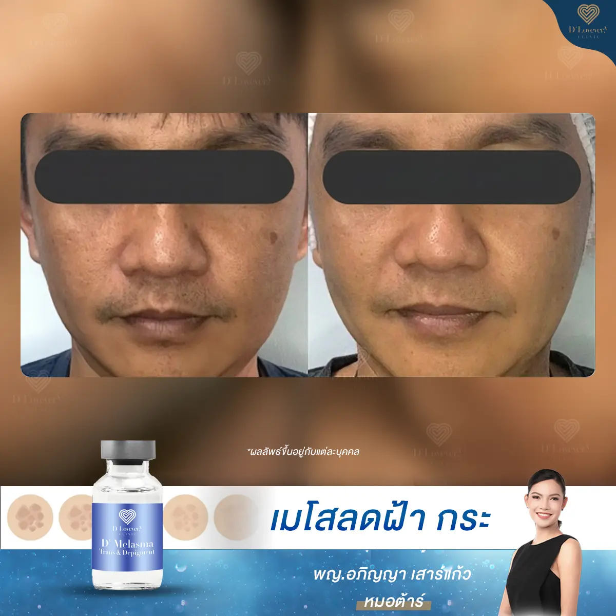 طرق طبيعية لعلاج الكلف والنمش بشكل كامل: مراجعة 2.