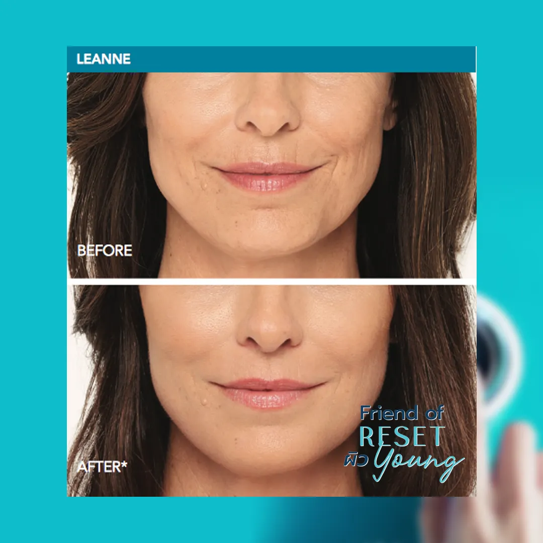 Radiesse before-and-after: reduced nasolabial and marionette lines, smoother lower face