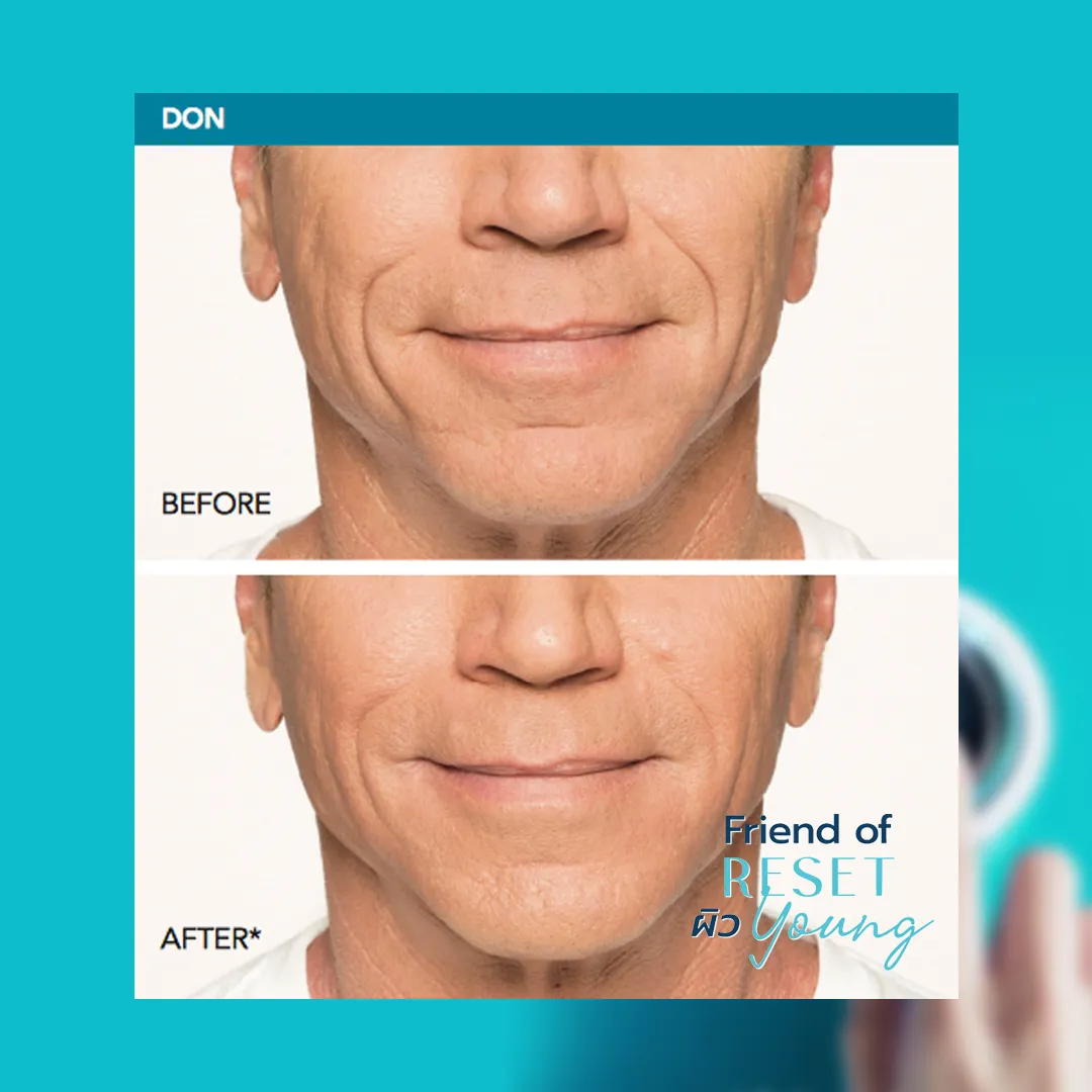 Radiesse before-and-after: reduced nasolabial folds and marionette lines on male lower face
