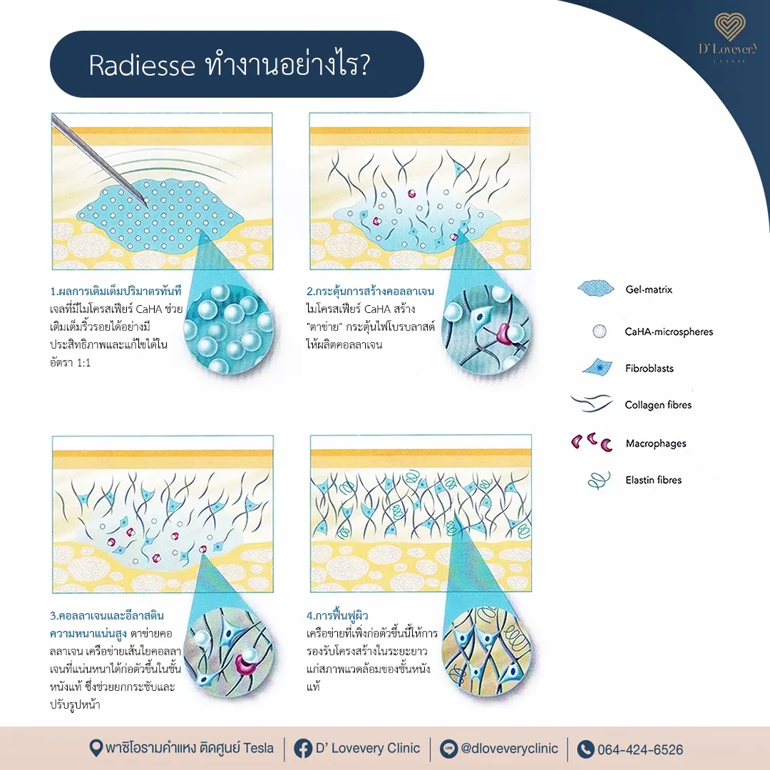 Radiesse ทำงานอย่างไร