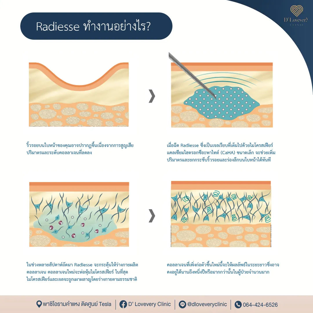 Radiesse ออกฤทธิ์อย่างไร