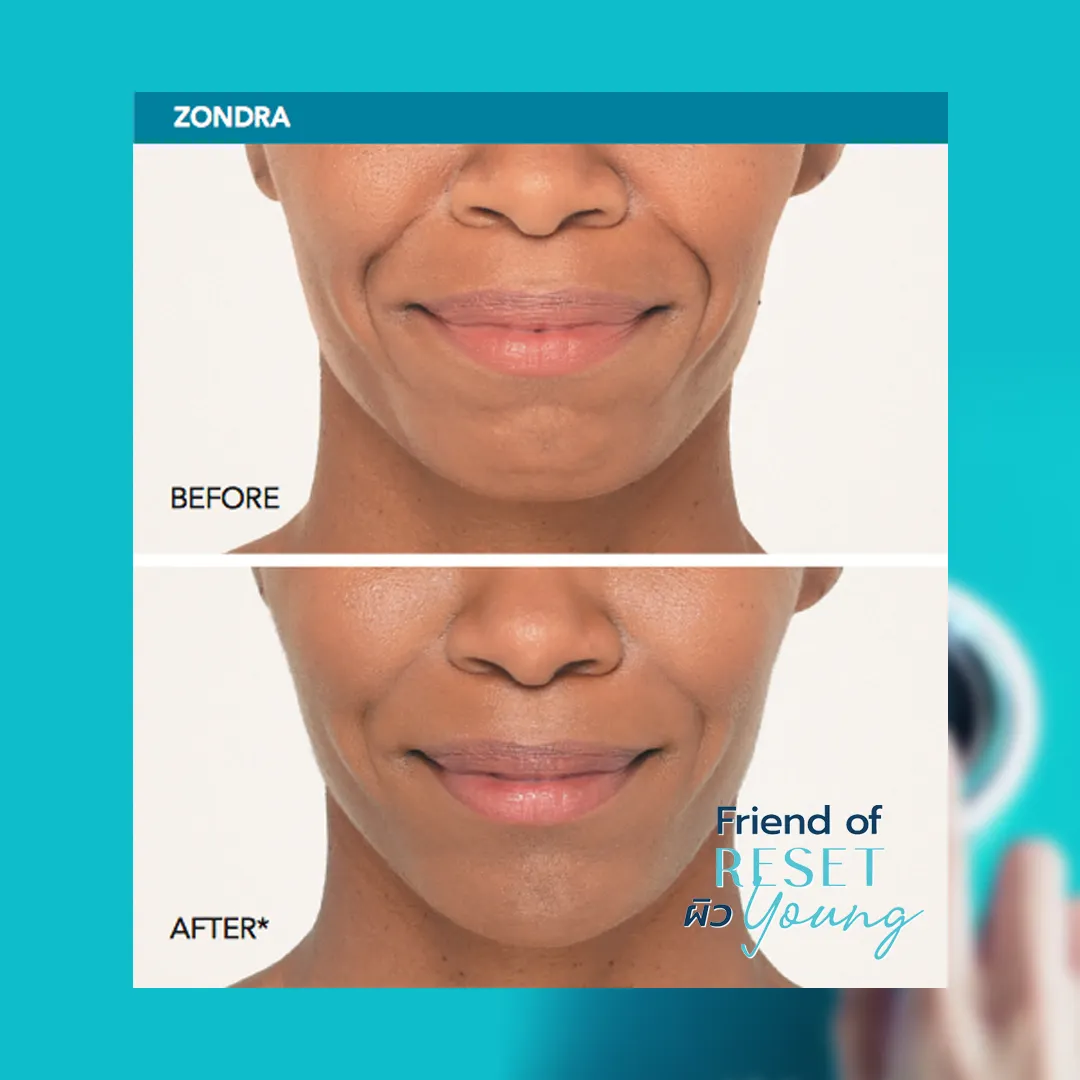 Radiesse filler before-and-after: softened nasolabial folds, smoother chin, fuller lips