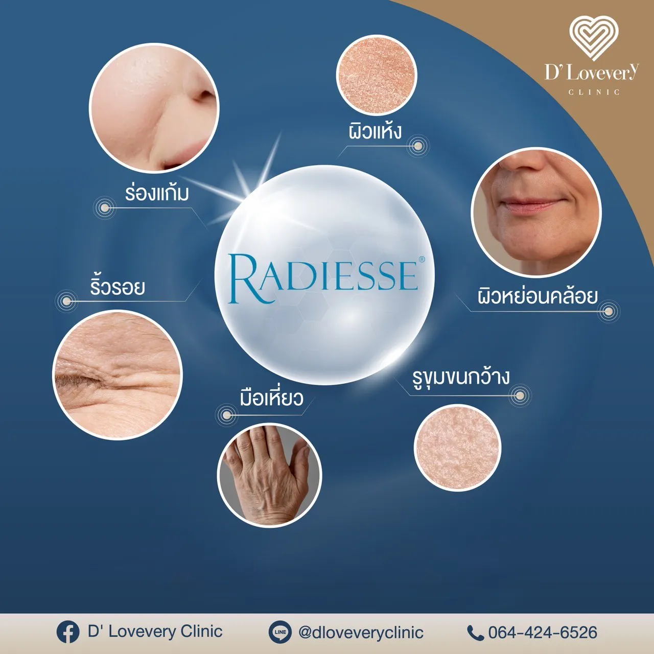 Radiesse ฉีดตรงไหนได้บ้าง