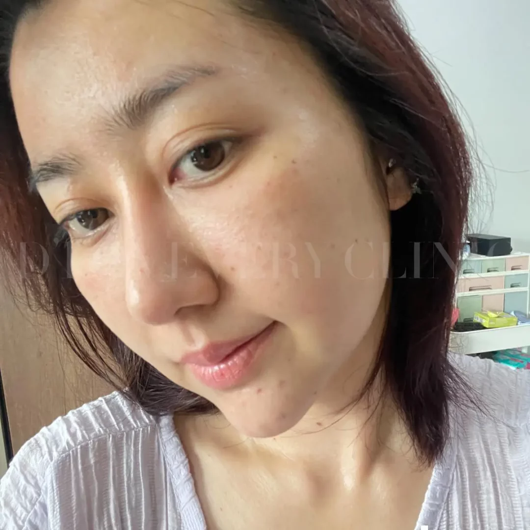 Woman close-up showing Rejuran results two days after treatment