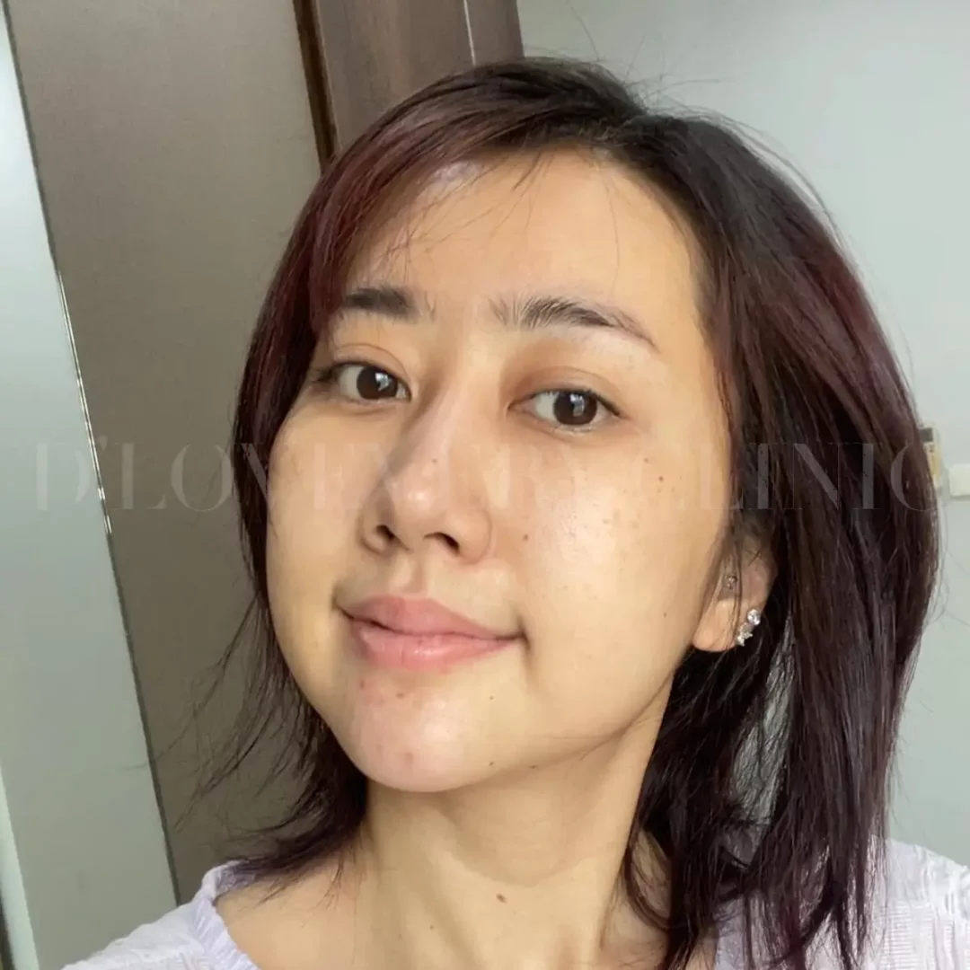 Before Rejuran injection selfie: woman with natural skin, shoulder-length brown hair.