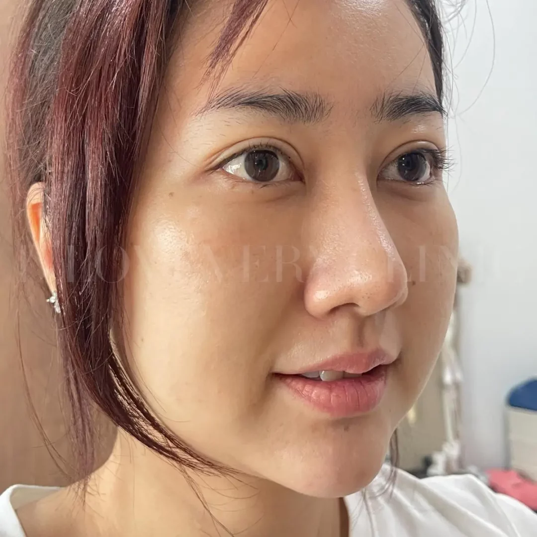 Rejuran one-week skin results — close-up of womans face with natural glow