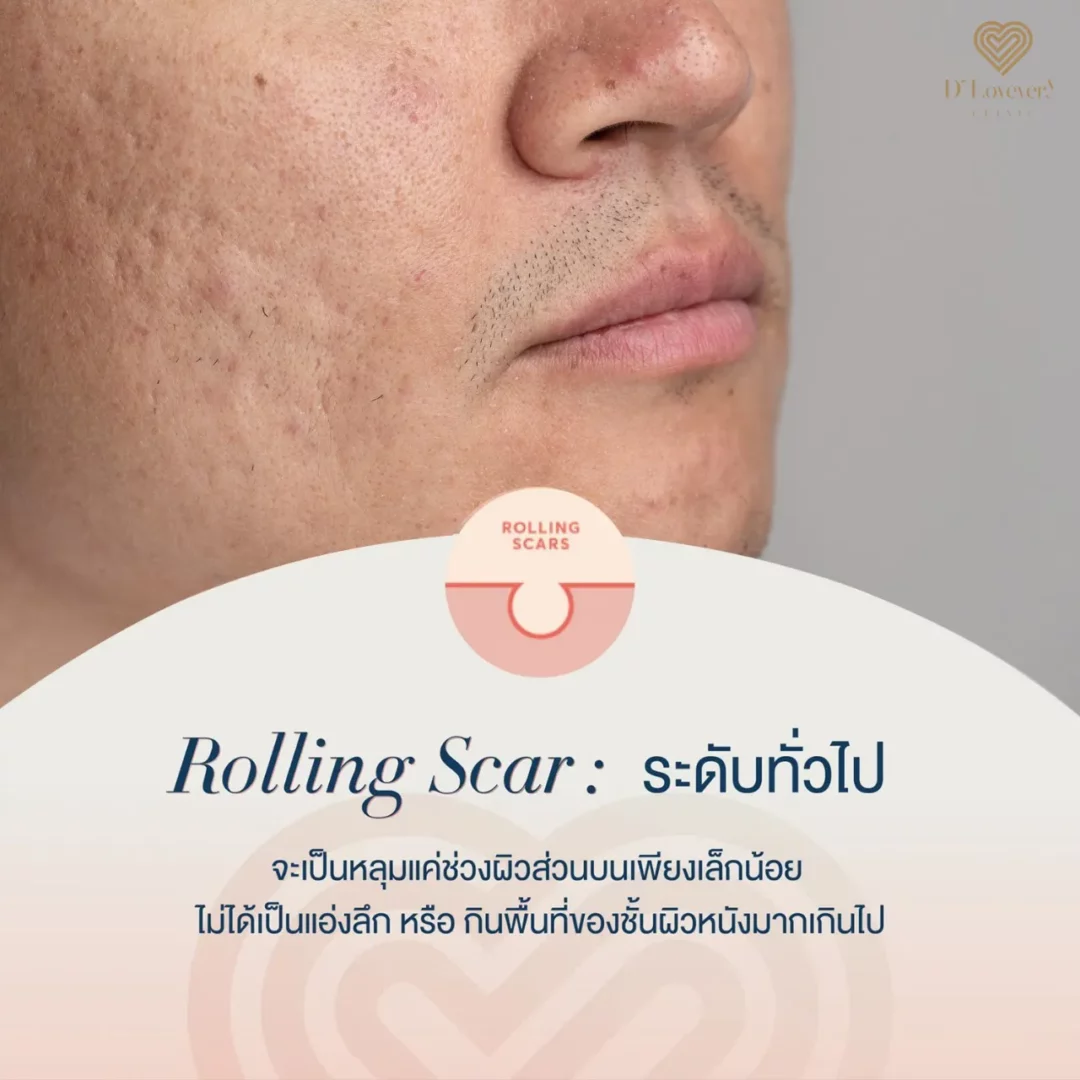 Clinical close-up of lower right cheek with rolling acne scars and enlarged pores