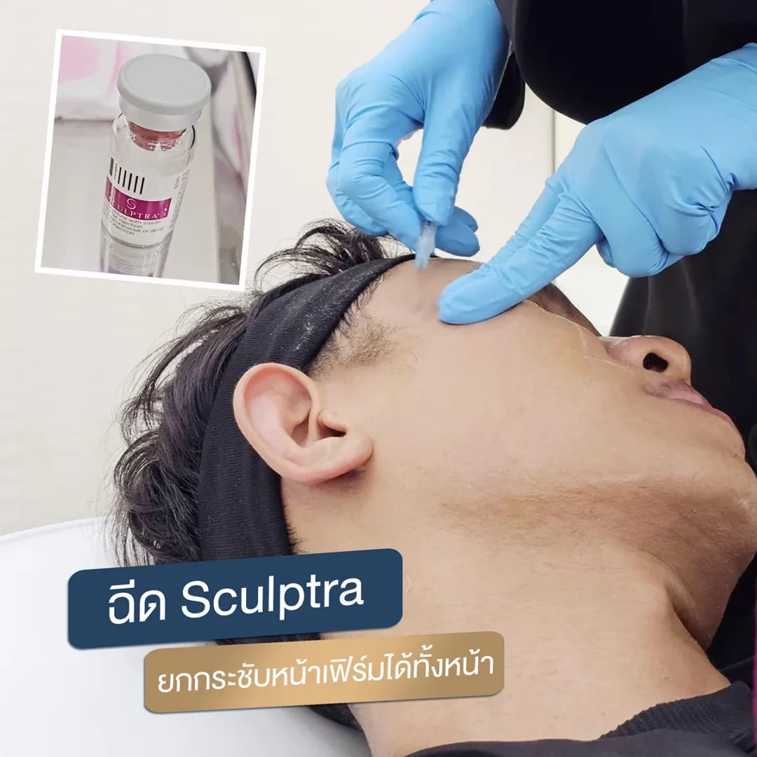 Male Sculptra injection in clinic: practitioner administering syringe to cheek with vial inset