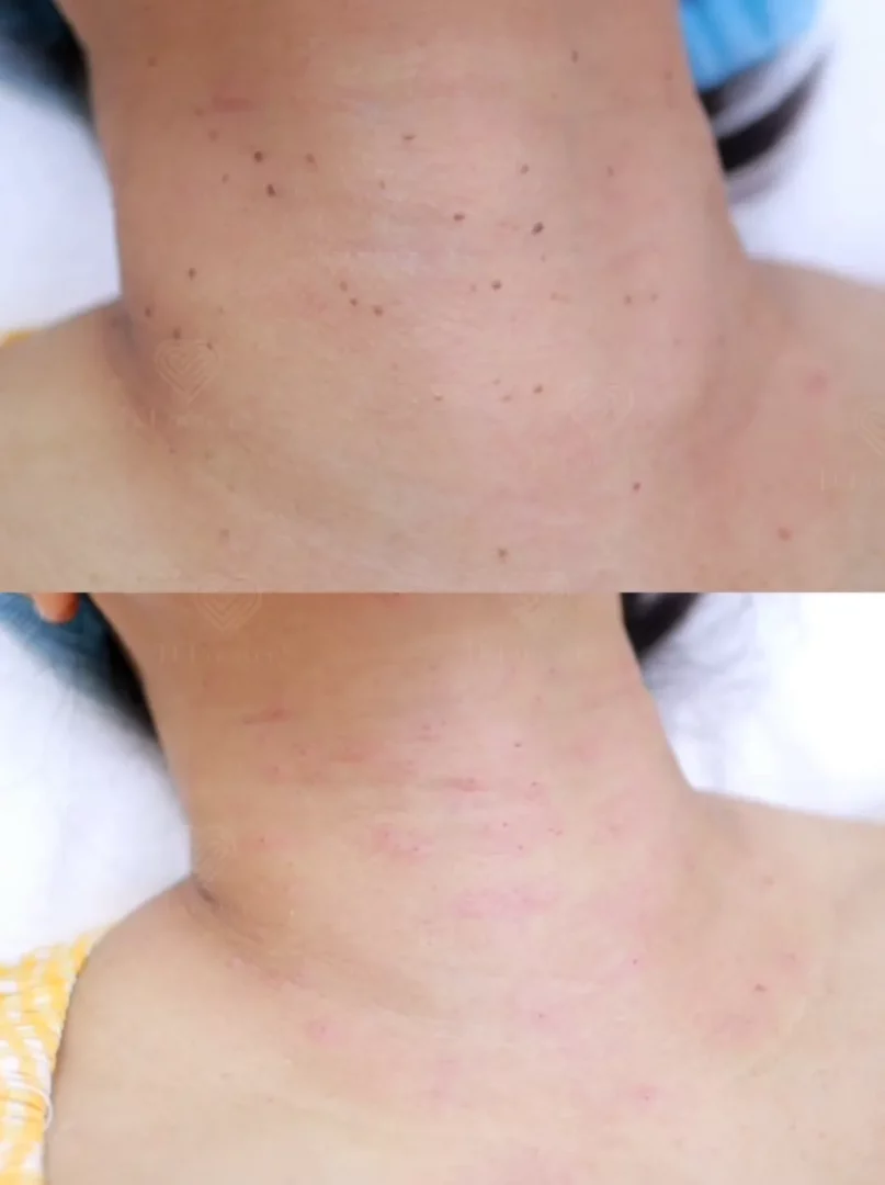 รีวิวจี้กระเนื้อ ติ่งเนื้อ ราคาเหมา 5000