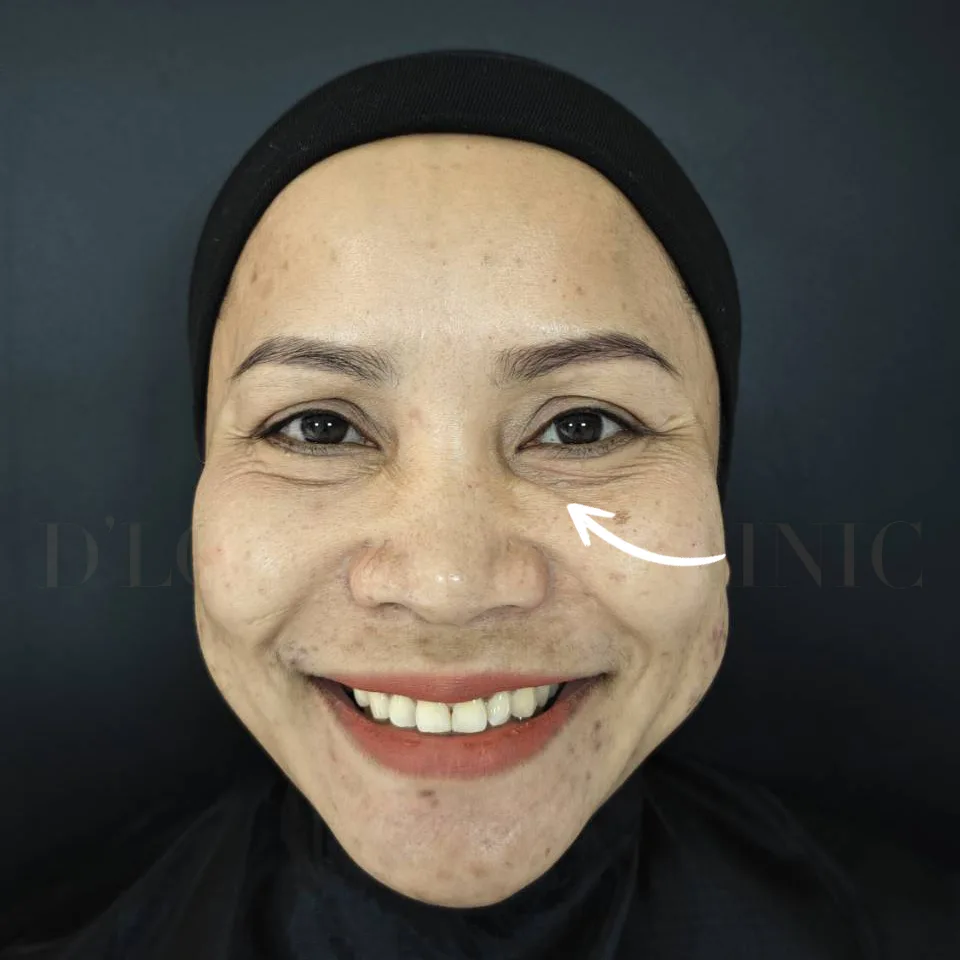 Close-up of smiling person in head covering showing under-eye lines and wrinkles
