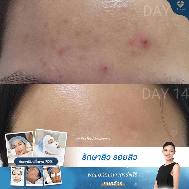Acne Removal No6 Before After