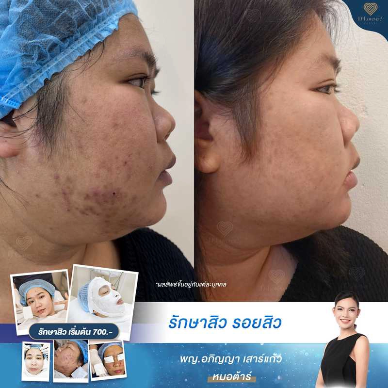 รีวิวรักษาสิวอักเสบ แพ้ครีม เริ่มต้น 700 บาท