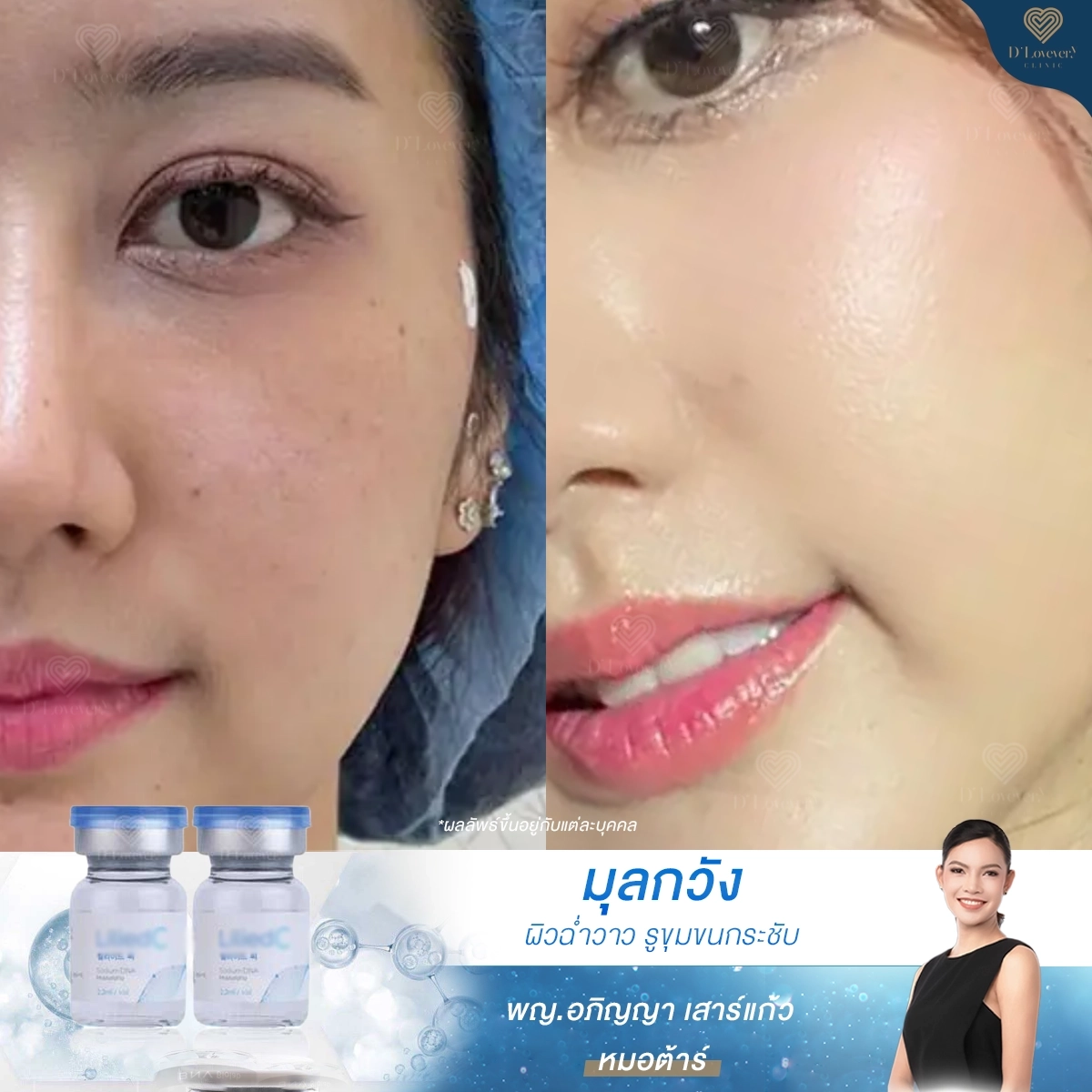 Hydration treatment before-and-after: visible pores and blemishes to smooth, dewy, glowing skin