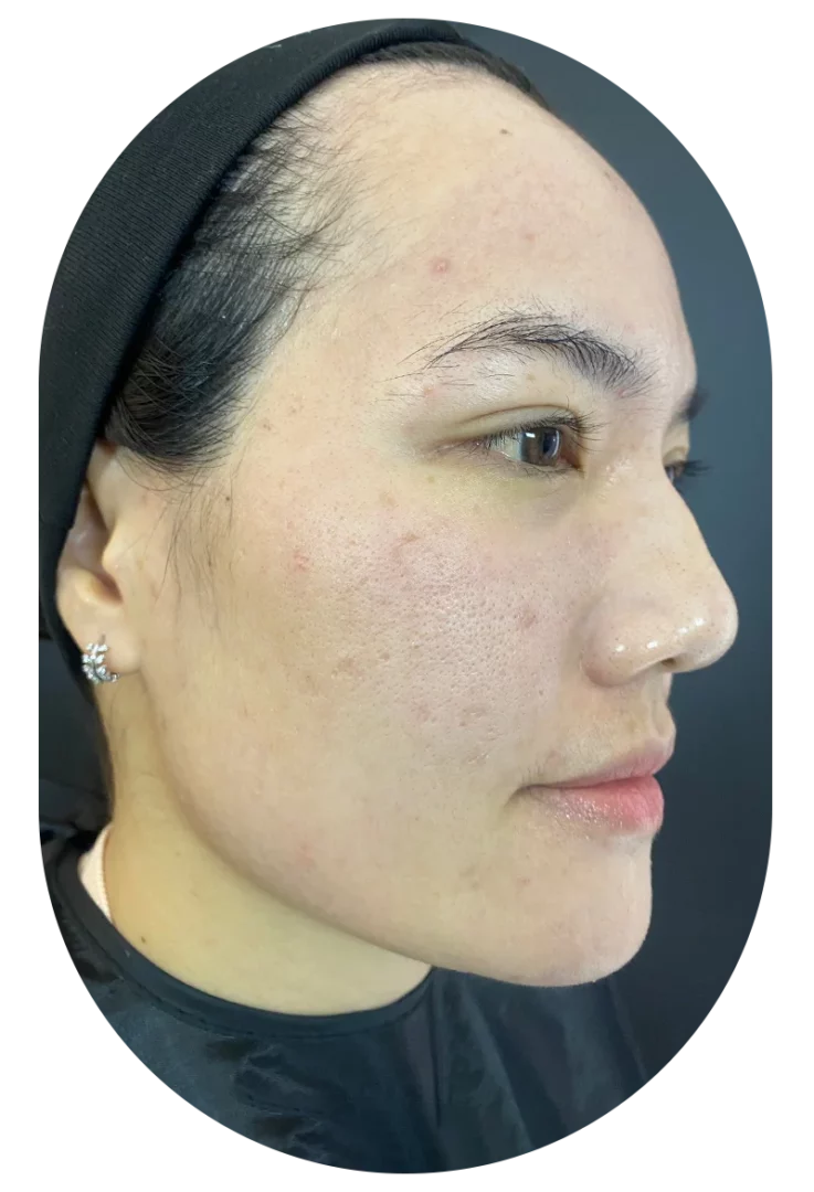 Before treatment close-up: acne scars and wide pores