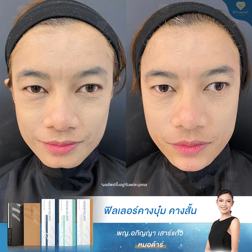 Case 13 Chin Filler Before After