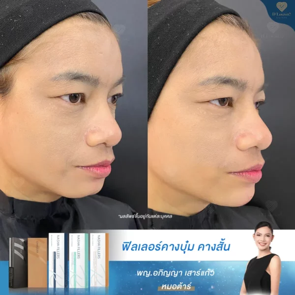 ฟิลเลอร์คาง คางบุ๋ม