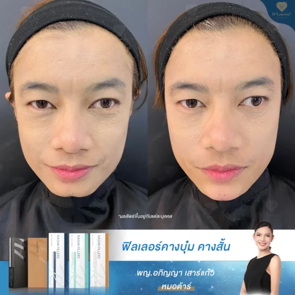 ฟิลเลอร์คาง คางบุ๋ม
