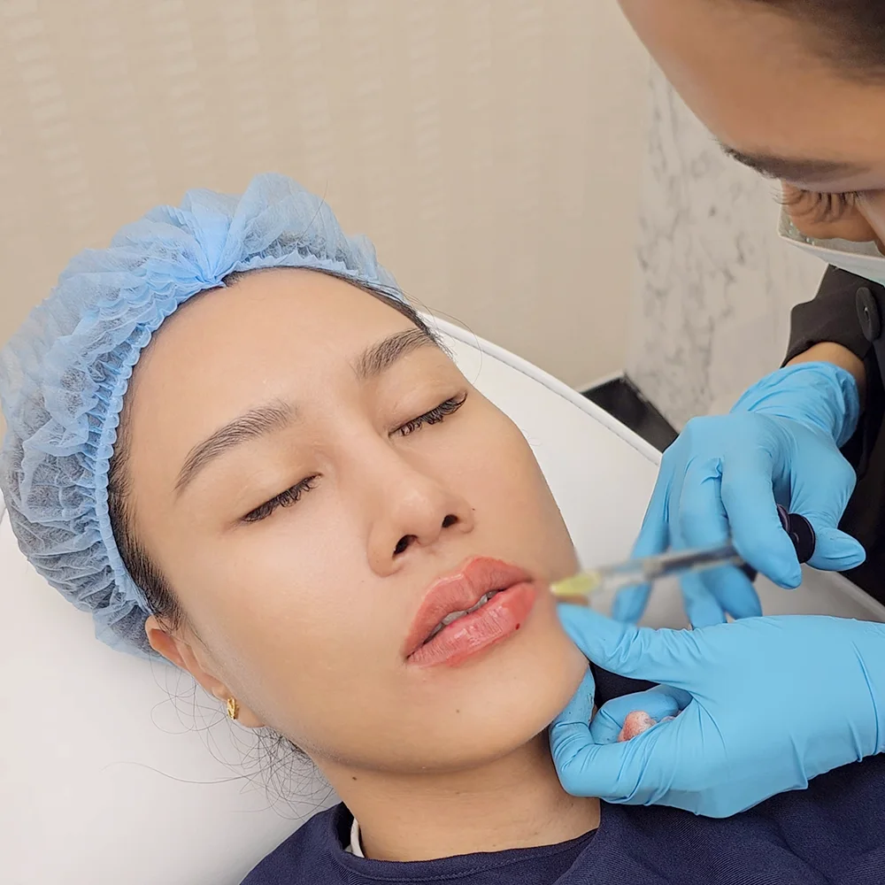 Lip filler injection: clinician in blue gloves injects patients lower lip.