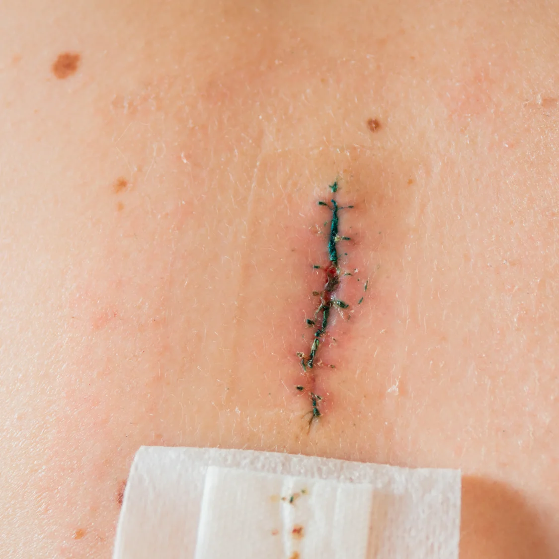 Healing surgical incision with interrupted sutures, mild redness, and small crusted scabs