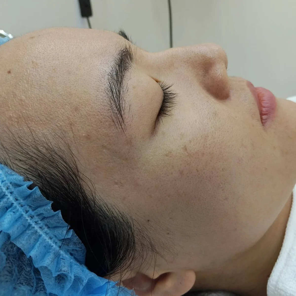 Profile facial close-up showing enlarged pores and acne-scar treatment