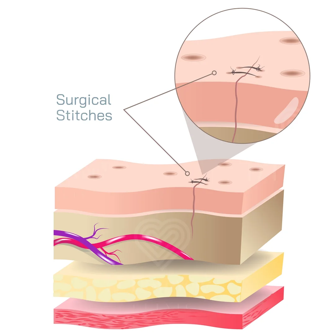 Surgical stitch cross-section illustrating skin layers and suture knot