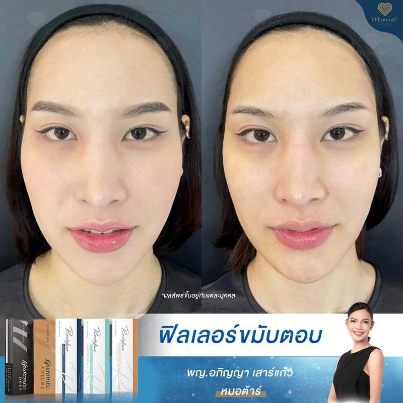 Subtle temple filler before and after frontal comparison