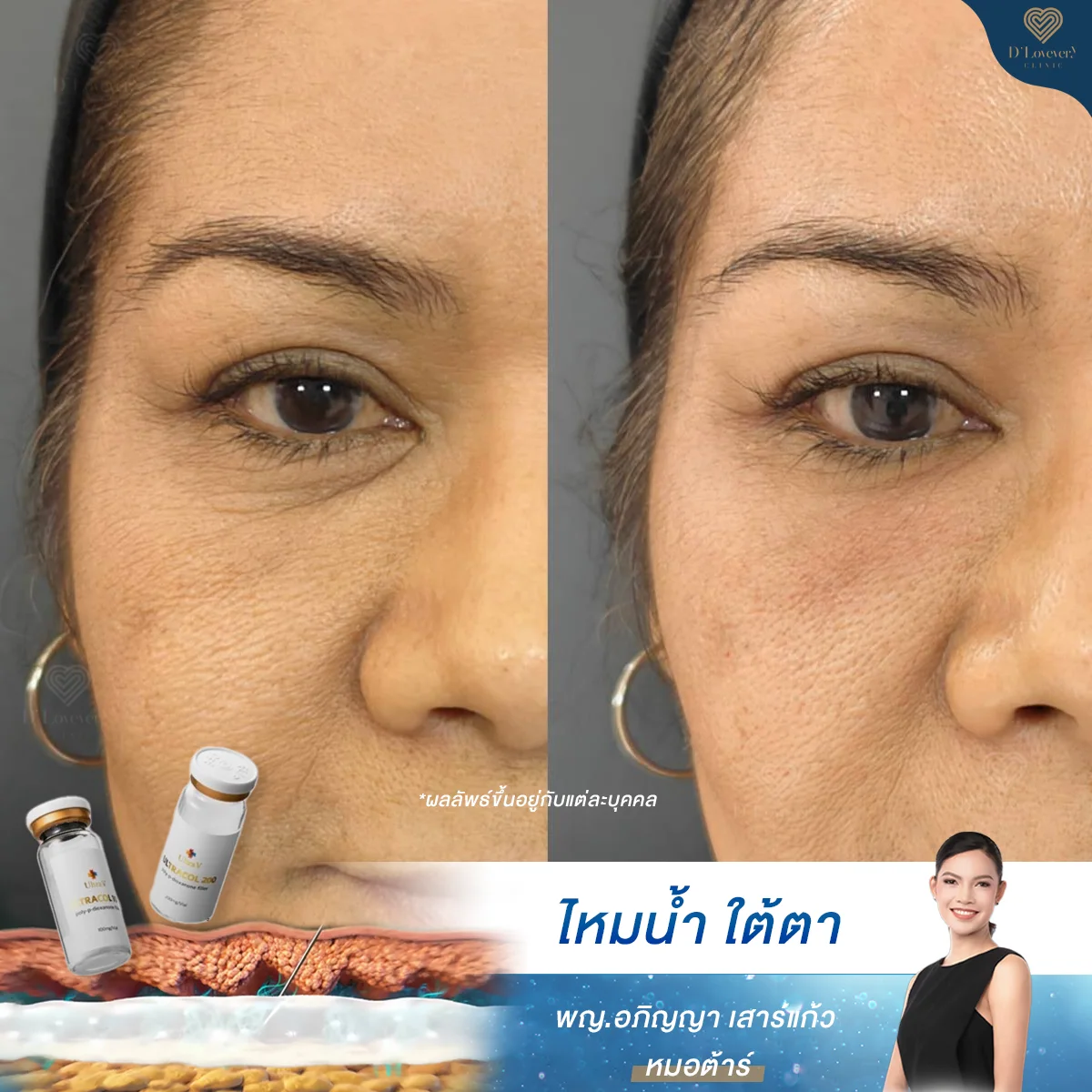Under-eye thread lift review