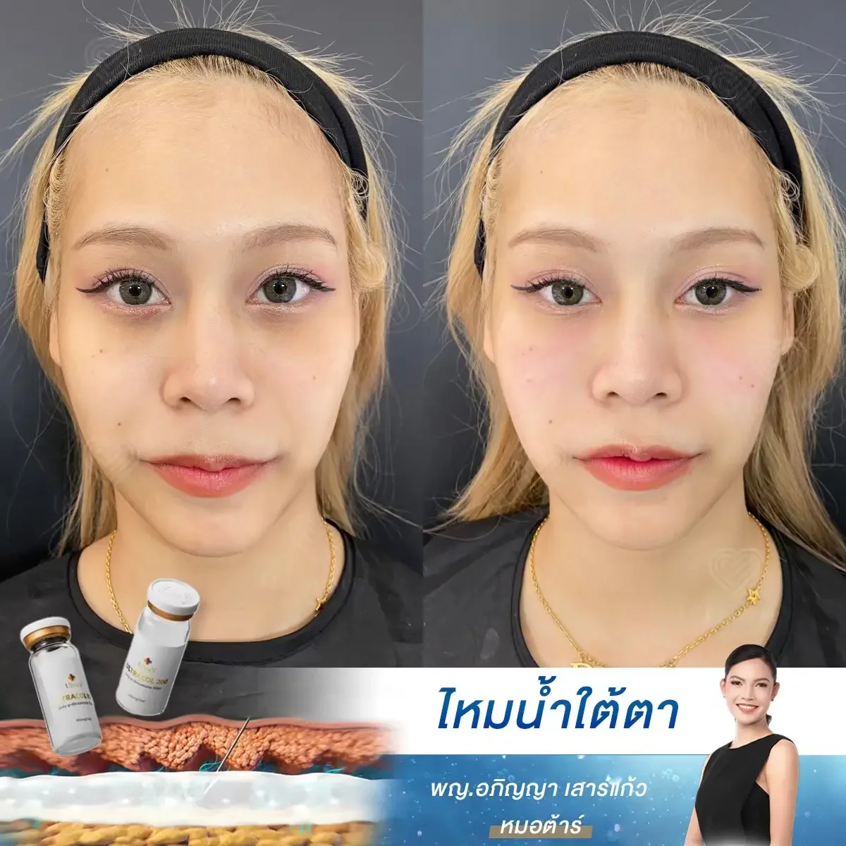 Ultracol Under Eye Before After