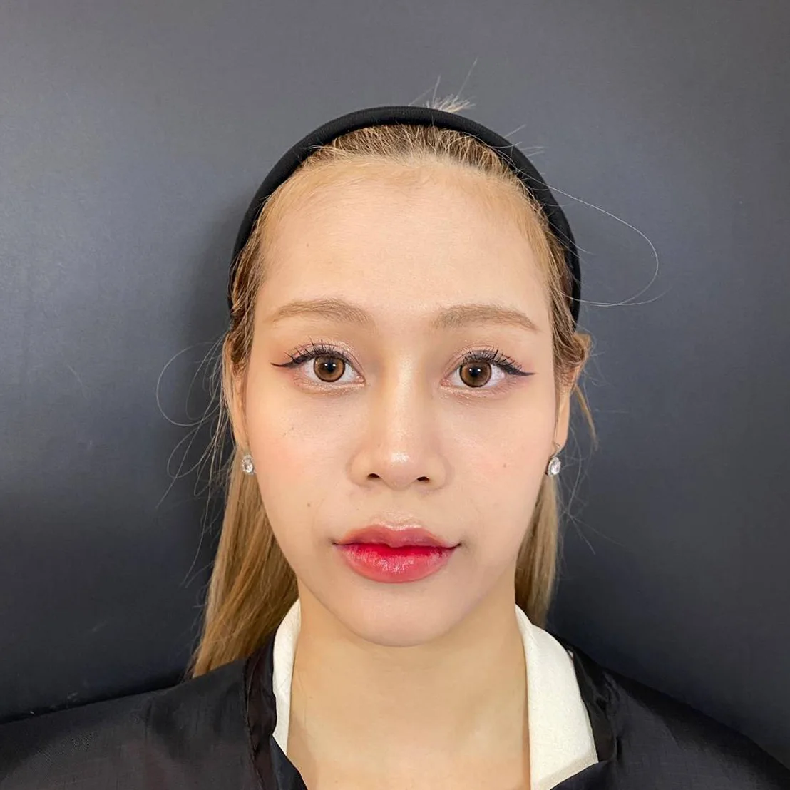 ไหมน้ำใต้ตา รีวิวหลังทำ 45 วัน